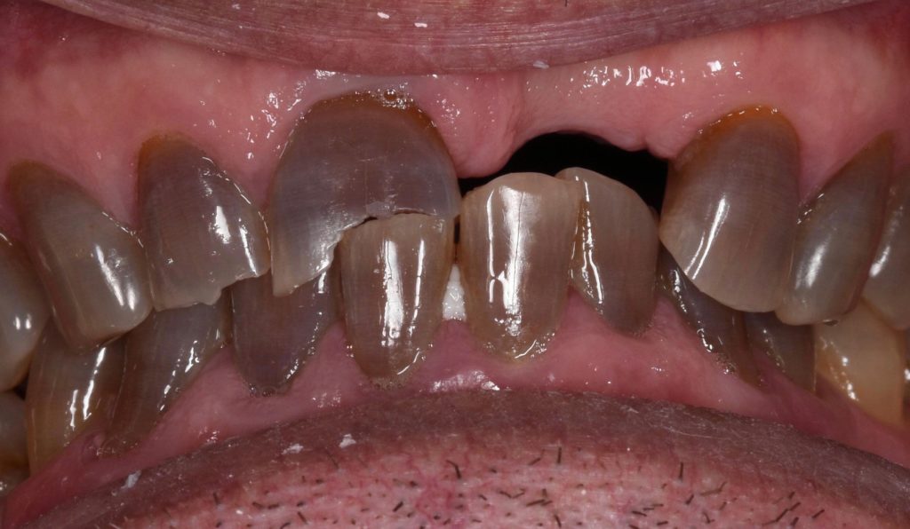 Worn, Cracked or Broken Teeth Bega Dental Practice